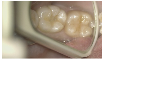 CR（コンポジットレジン）による審美歯科治療の1例 | 国立の歯医者｜国立t歯科