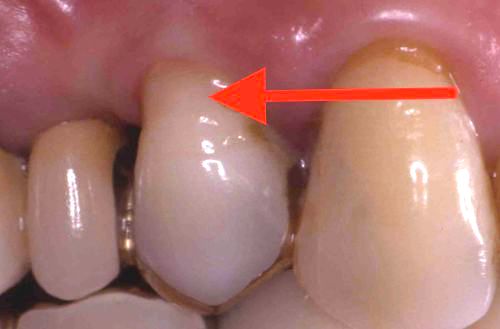 くさび状に欠損した歯の経過