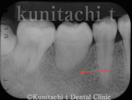 親知らず移植後3ヶ月のレントゲン