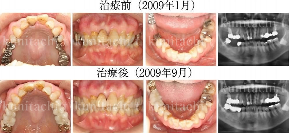 顎 関節 症 治療