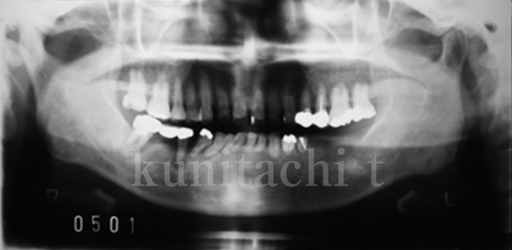 初診時のレントゲン