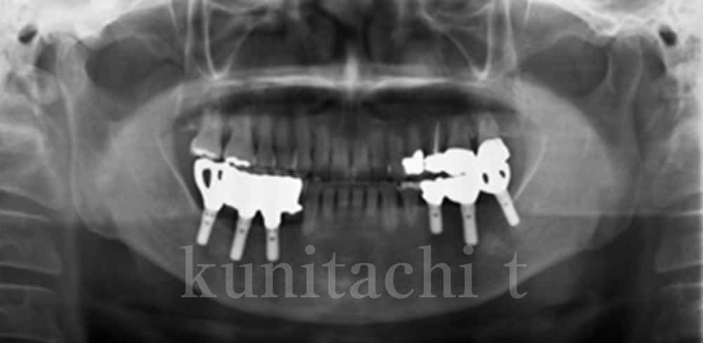 治療後のレントゲン