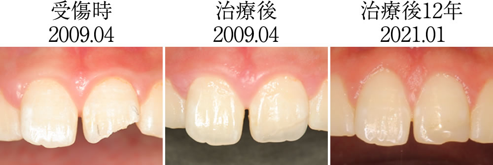 治療前後の前歯の比較・経過