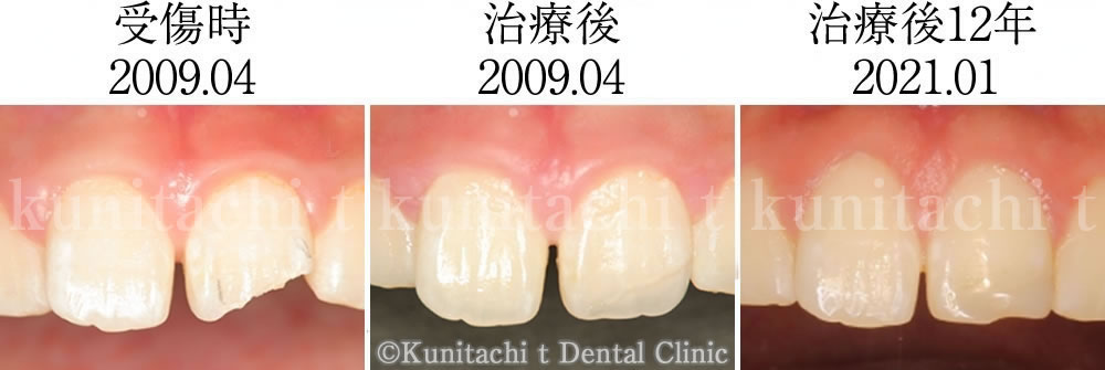 治療前後の前歯の比較・経過