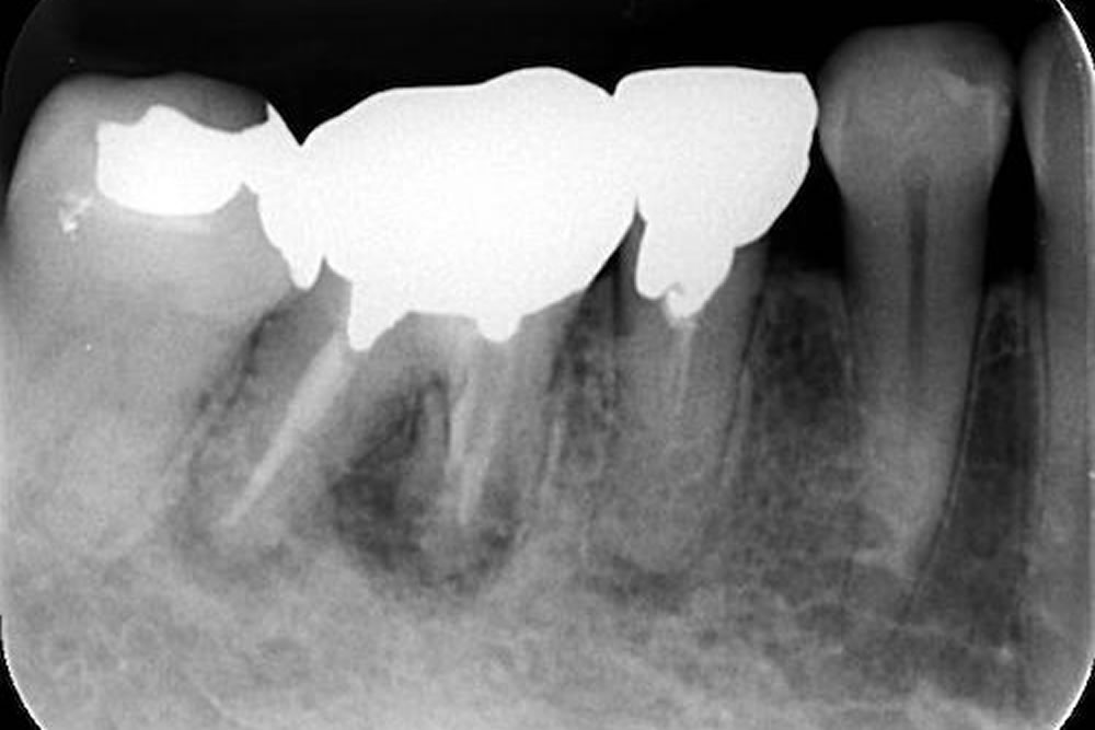 根管治療で抜歯を回避した症例