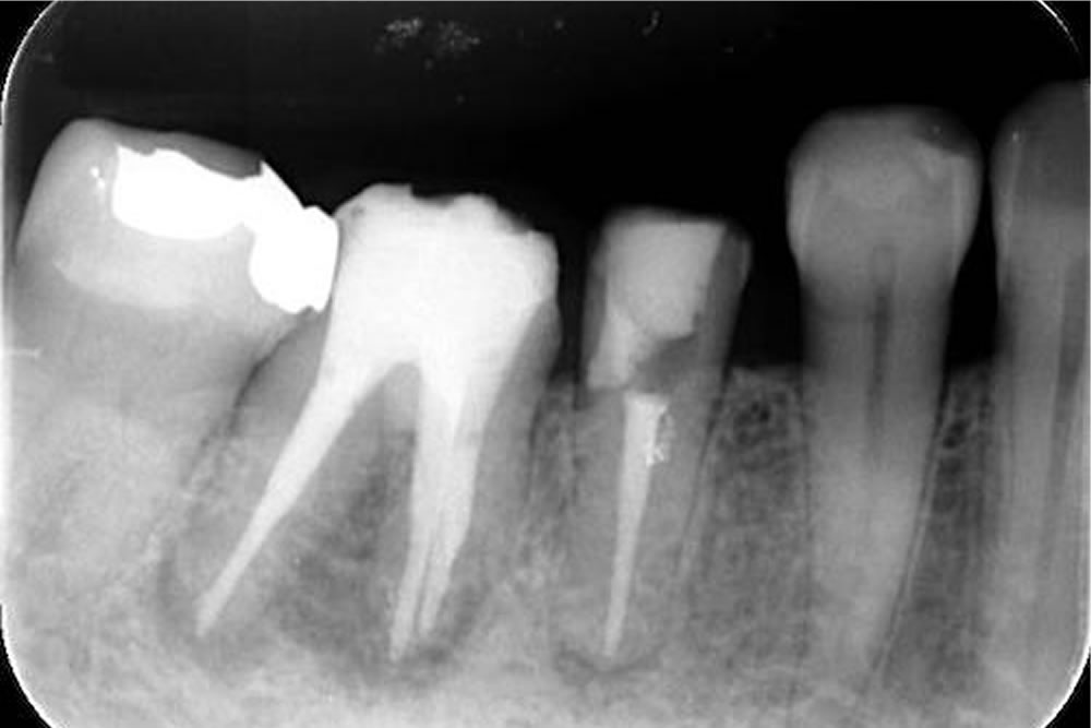 根管治療で抜歯を回避した症例