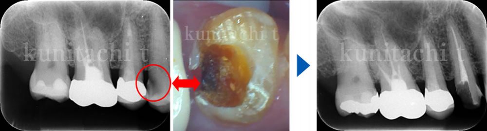 根管治療の実施