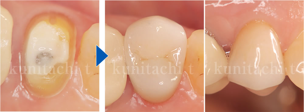 補綴治療の実施(かぶせ物の装着)