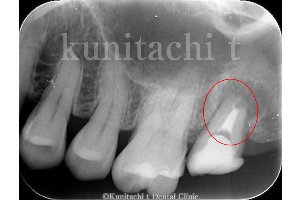 仮歯を装着して治療完了