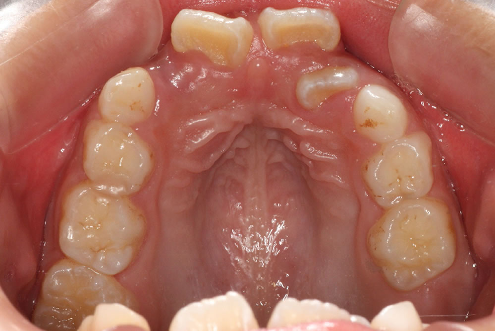 小学生の凸凹歯列の矯正治療