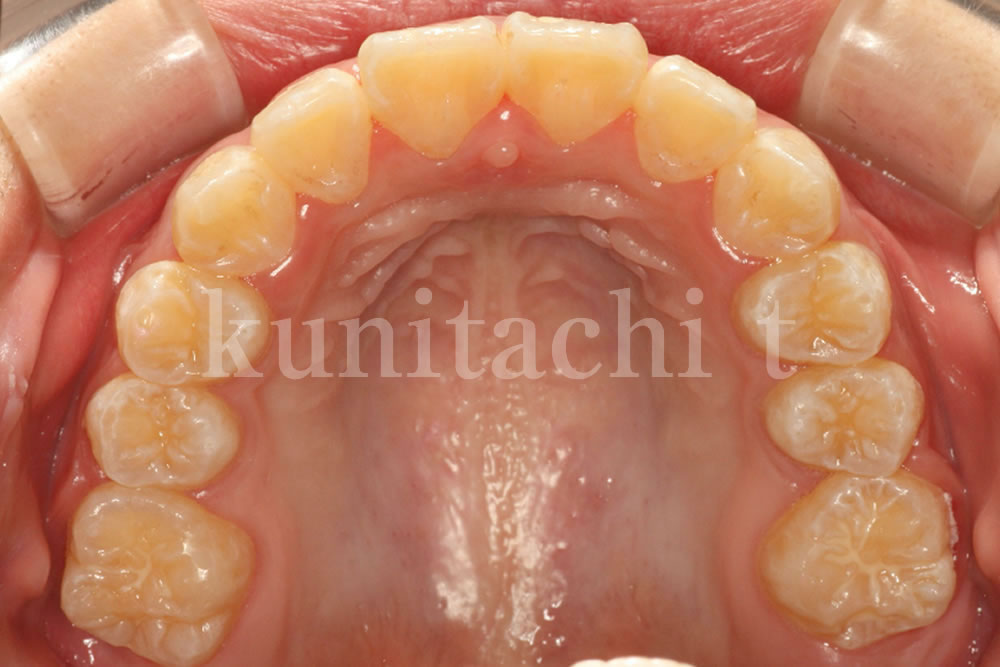 顎が小さいことで起こる凸凹歯並びの歯科矯正（8歳小学生） | 国立ｔ歯科