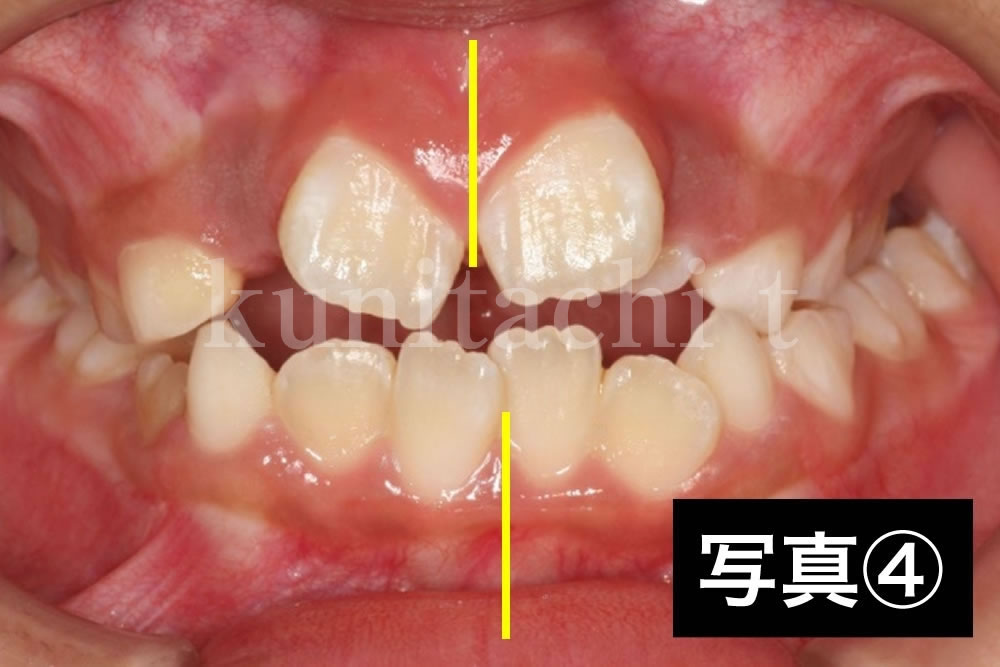 顎が小さいことで起こる凸凹歯並びの歯科矯正 8歳小学生 国立の歯医者 国立ｔ歯科