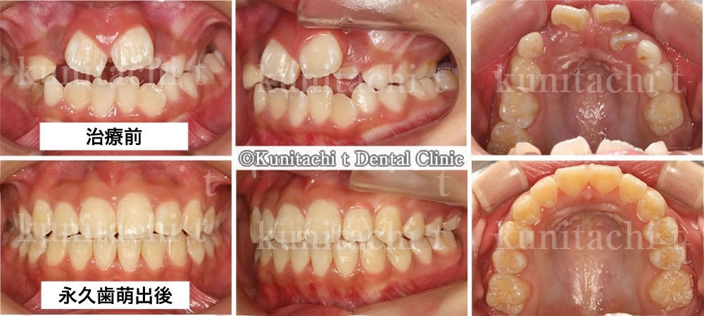 小学生の凸凹歯列の矯正治療