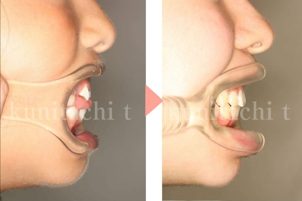 顎が小さいことで起こる凸凹歯並びの歯科矯正 8歳小学生 国立の歯医者 国立ｔ歯科