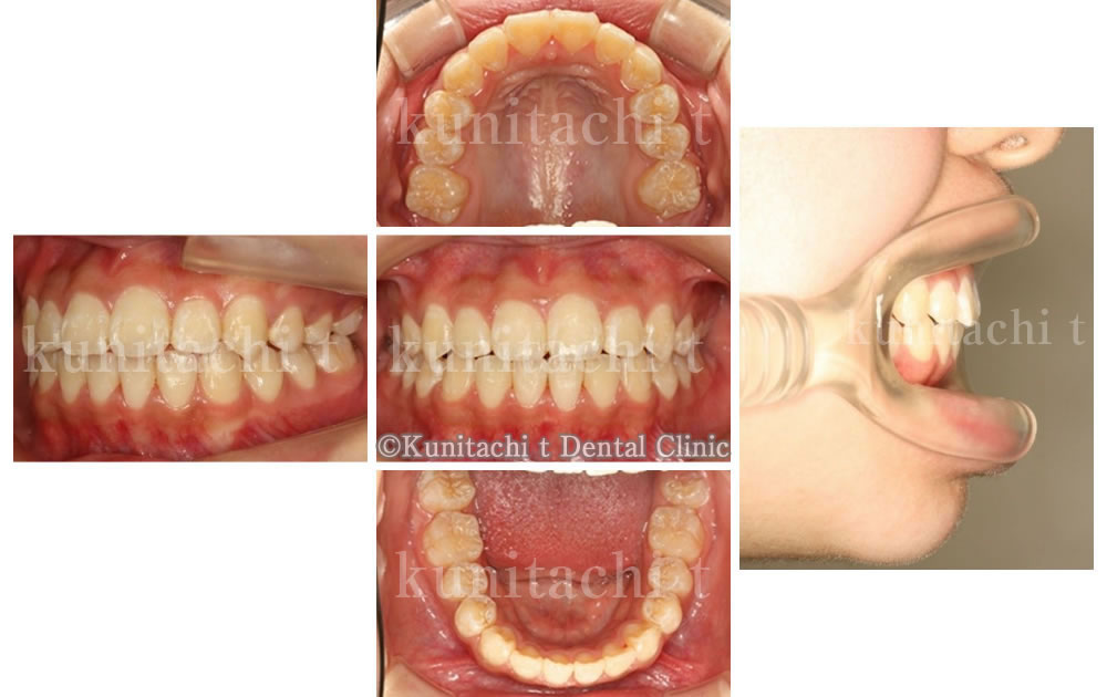 叢生・開咬の矯正治療症例