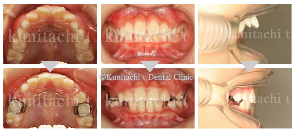 出っ歯の矯正治療症例