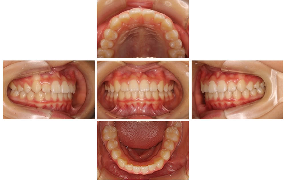 出っ歯の矯正治療症例