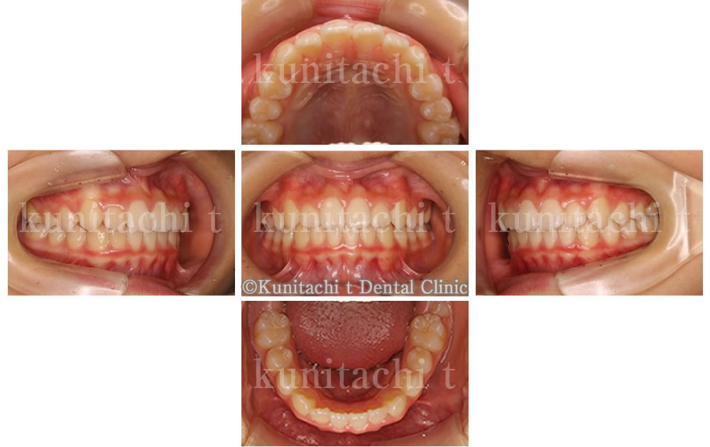 出っ歯の矯正治療症例
