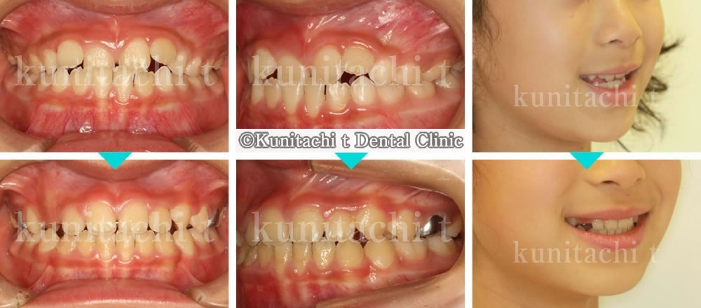 子供の受け口の治療例