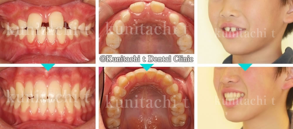 子供のすきっ歯の治療例
