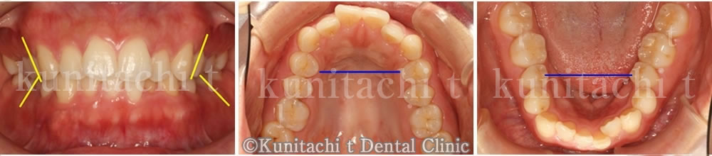 前歯部の叢生