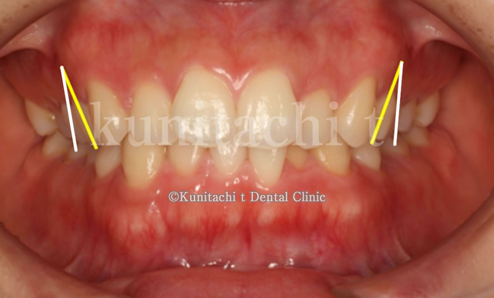前歯部の叢生