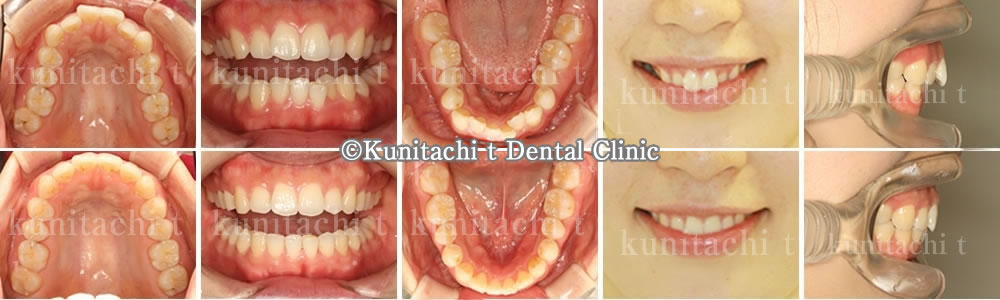 出っ歯と叢生の治療例