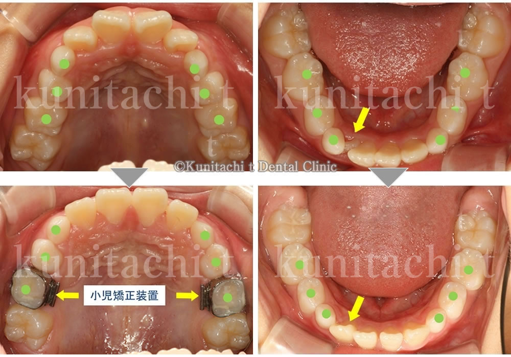 上顎・下顎狭窄の拡大