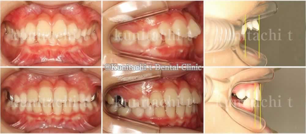 噛み合わせ・前歯の傾斜を改善