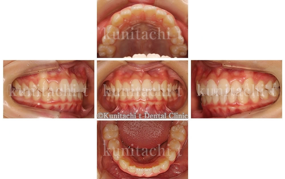 永久歯が生え揃った後の口腔内