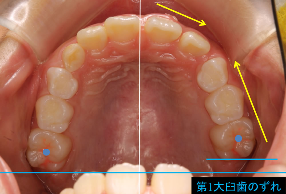 上前歯の隙間の原因