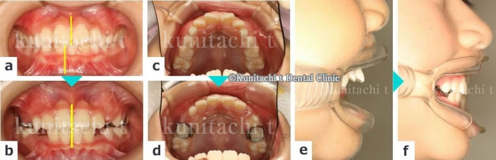 子供の出っ歯の治療例