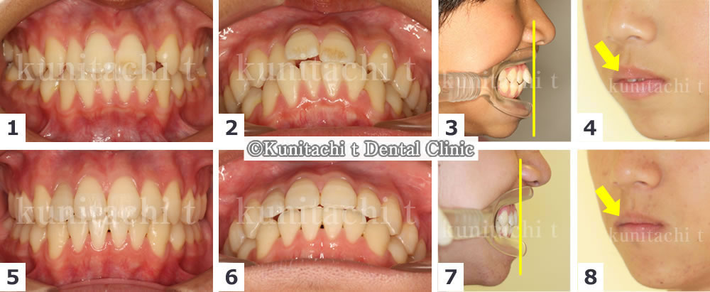 出っ歯と叢生の治療例