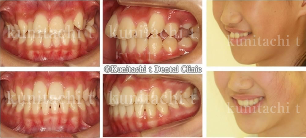 出っ歯と叢生の治療例