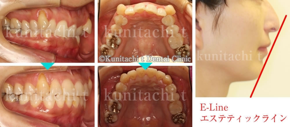 深い咬み合わせ（過蓋咬合）の矯正治療例（30代女性 治療期間1年10ヶ月）
