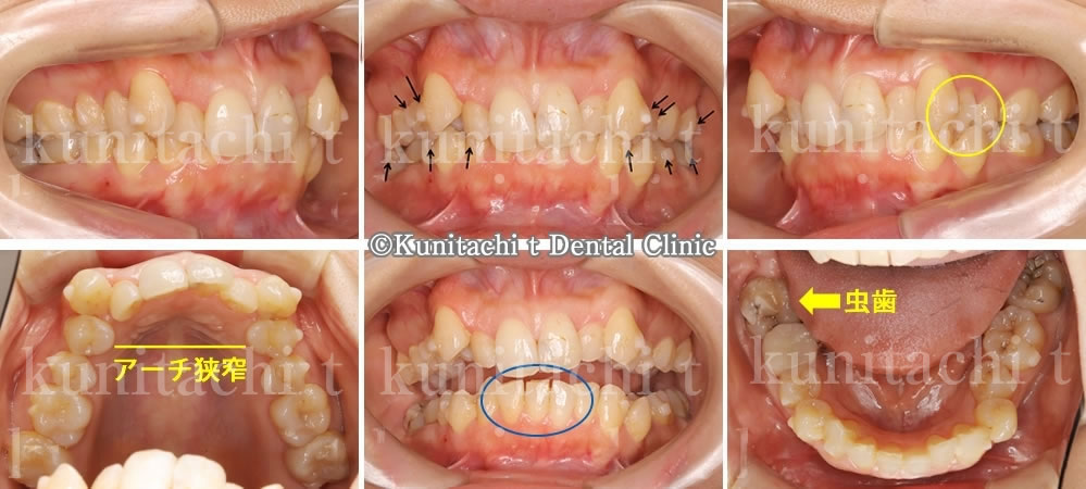 叢生・深い噛み合わせ(過蓋咬合)の矯正治療例（20代女性 治療期間2年6ヶ月）
