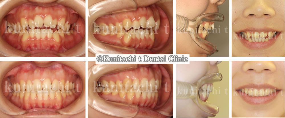開咬の矯正治療例（20代女性 治療期間1年10ヶ月） 国立市の歯医者｜壱番館デンタルオフィス
