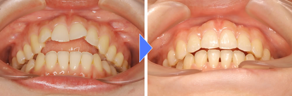側方歯　歯軸内側の治療前後の比較