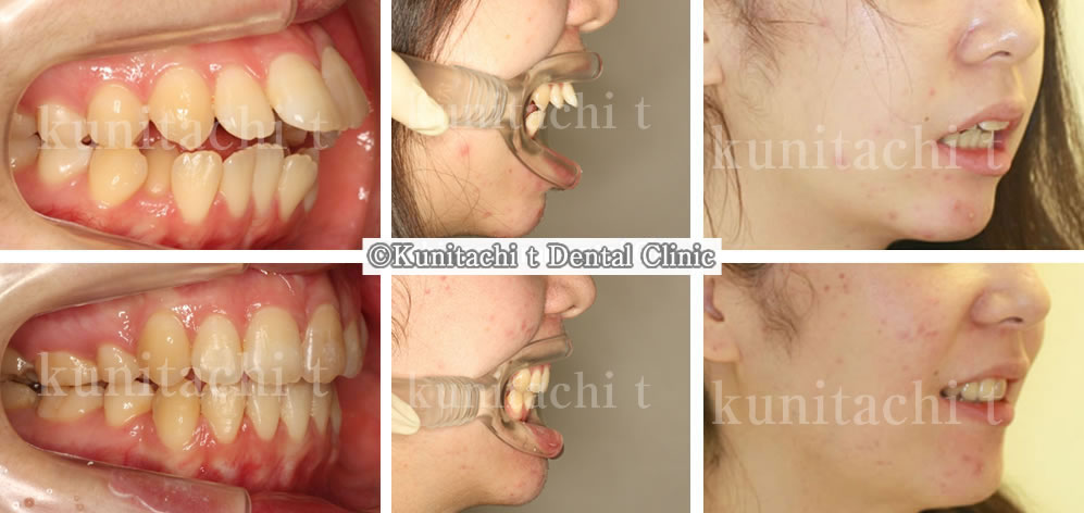 出っ歯(上顎前突)の高校生の治療例