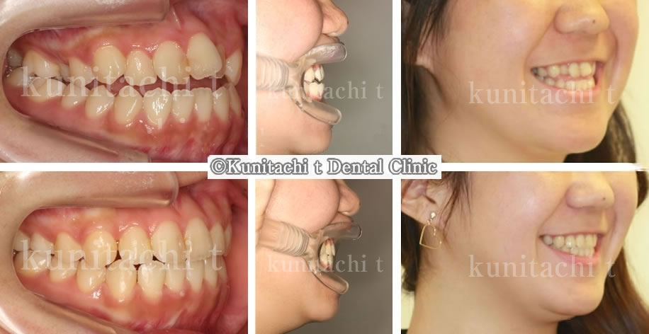 反対咬合（受け口）＆開咬の高校生の矯正治療例
