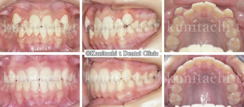 叢生の矯正治療例 女子中学生 治療期間1年 国立の歯医者 国立ｔ歯科
