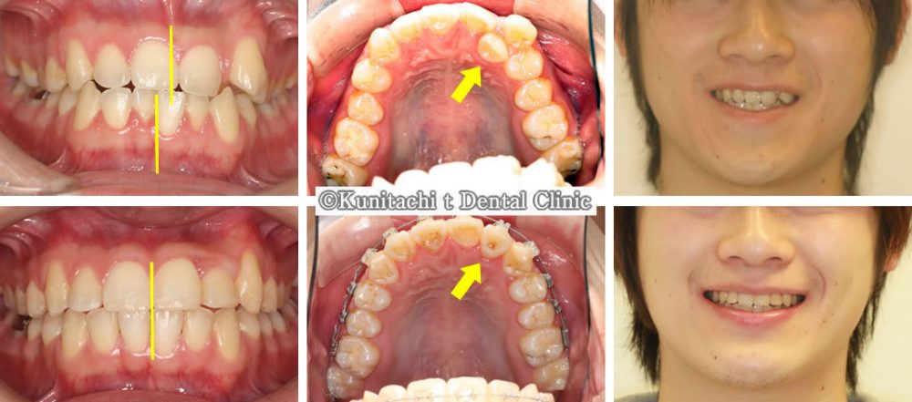前歯が重なっている八重歯の治療例
