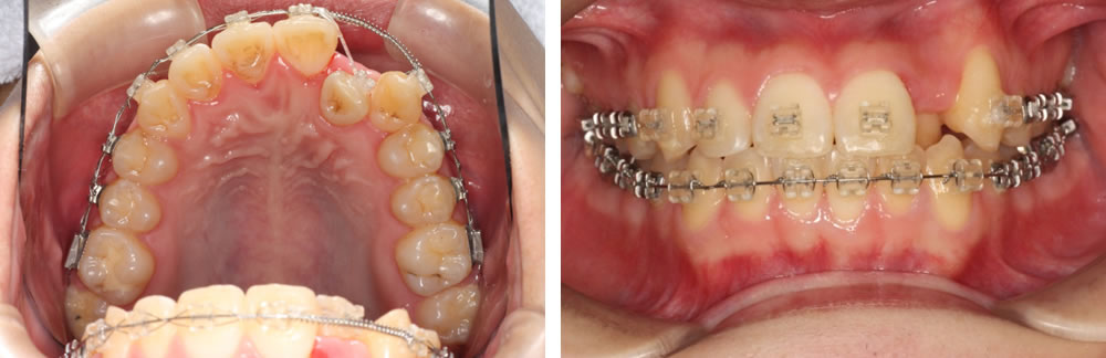前歯が重なっている八重歯の治療例