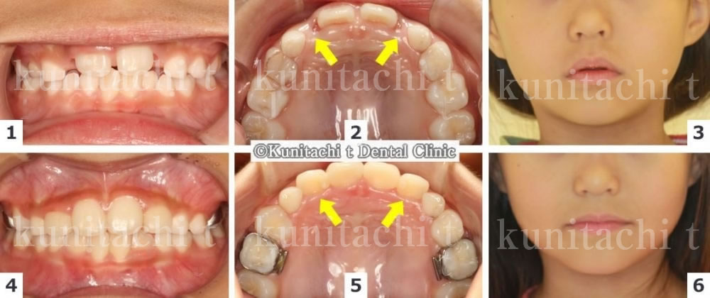 子供の歯並びと改善と鼻づまり解消症例 国立の歯医者 国立ｔ歯科