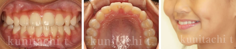 歯科矯正治療後