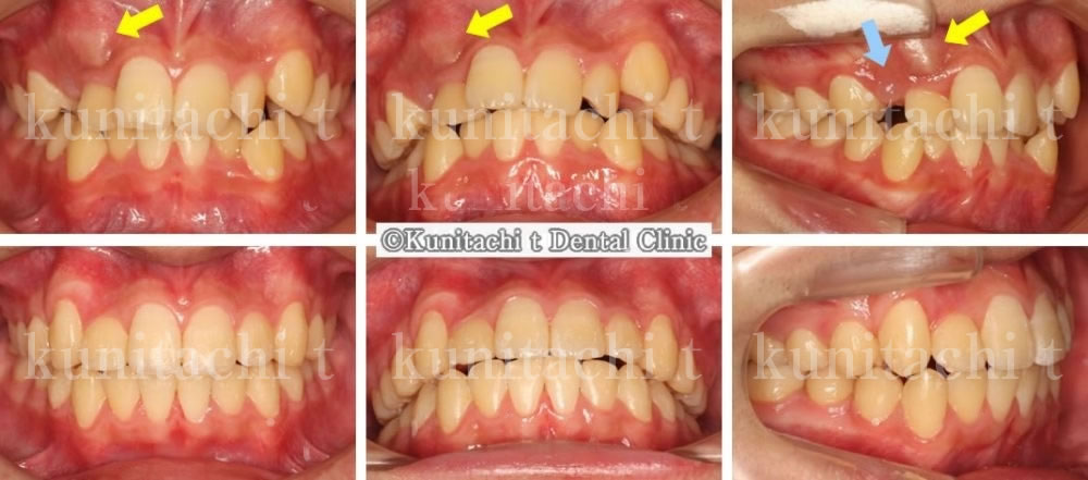 すきっ歯(犬歯が埋まっている)の治療例