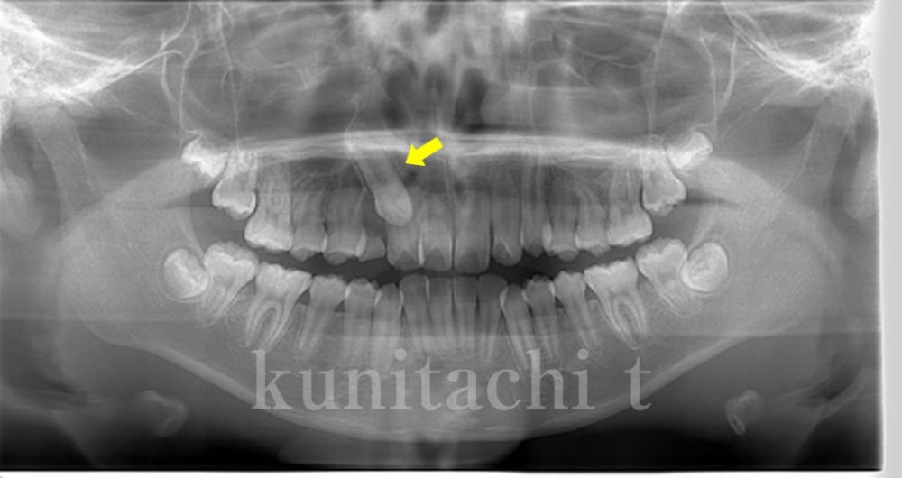 すきっ歯(犬歯が埋まっている)のレントゲン