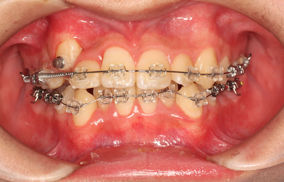 すきっ歯(犬歯が埋まっている)のレントゲン
