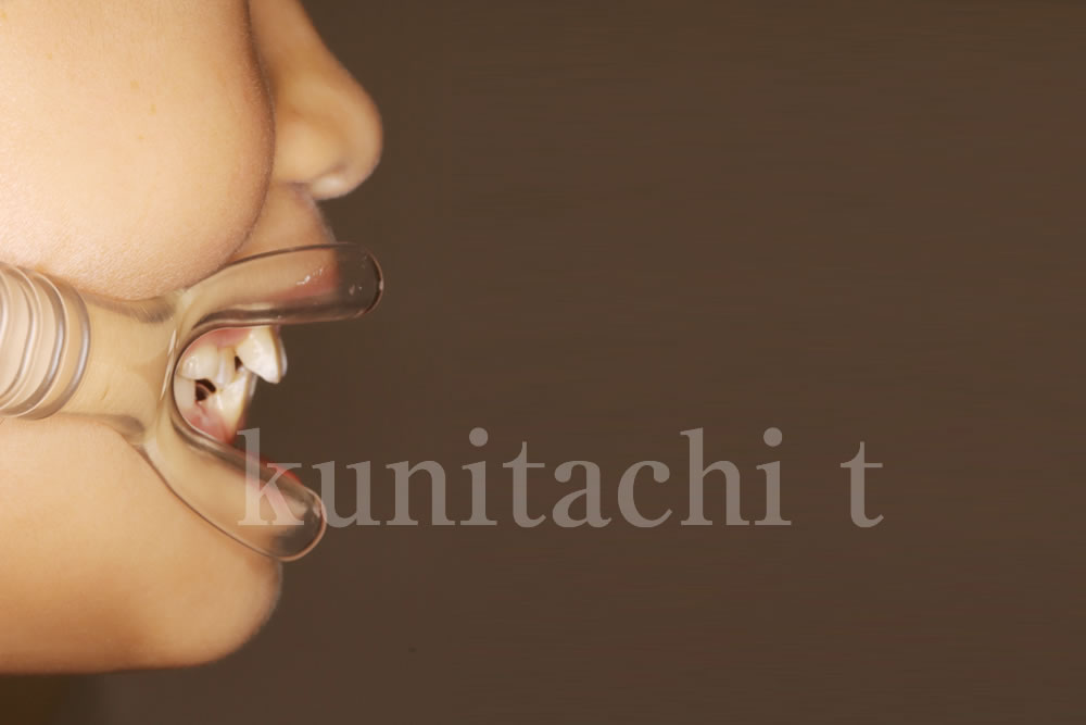 初診時の口腔内