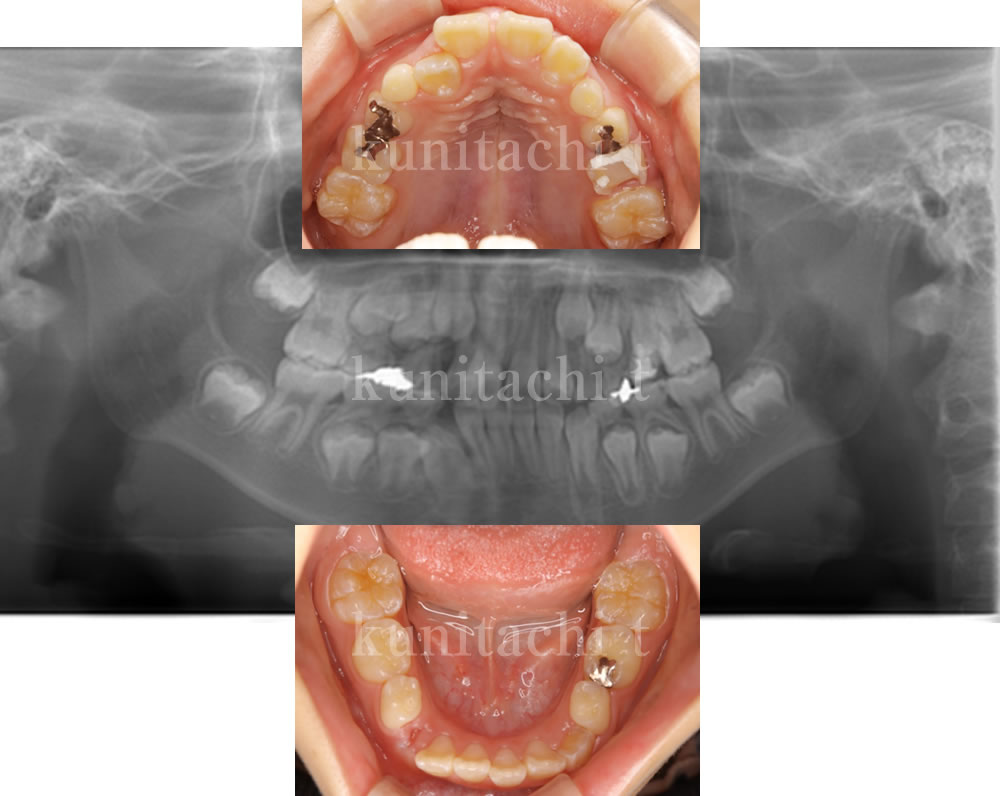 初診時のレントゲン画像